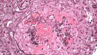 Necrotizing and Cresentic Glomerulonephritis in a patient with anti-GBM Disease